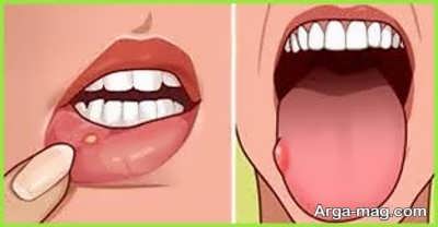 درمان طبیعی آفت دهان