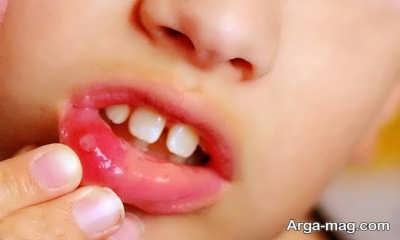 روش های سریع برای درمان آفت دهان