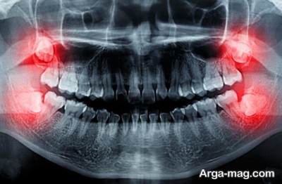 ارائه راهکار های مختلف برای تسکین درد دندان عقل