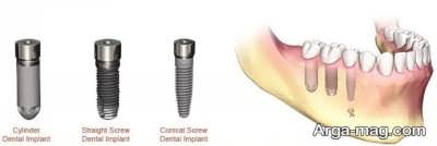 روش های متوالی ایمپلنت دندان