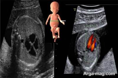علت اکوی قلب جنین چیست و چگونه انجانم می شود