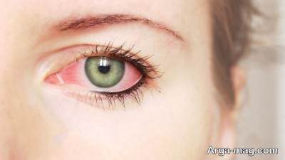 علائم و درمان عفونت چشم