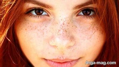 روش های خانگی برای از بین بردن لکه های پوستی