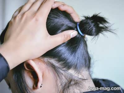 درمان ریزش مو با اسپیرونولاکتون