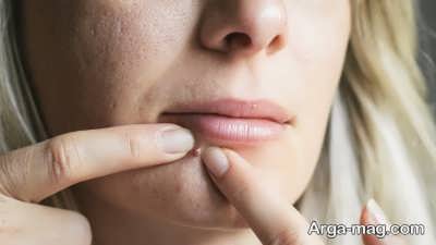 درمان جوش صورت با اسپیرونولاکتون