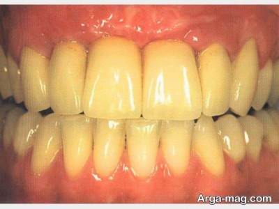 پیشگیری از زرد شدن دندان 