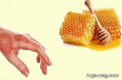 معجزه عسل جهت درمان فوزی سوختگی