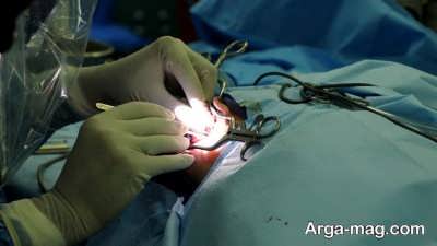 عمل جراحی کاشت حلزون