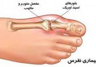 بیماری نقرس