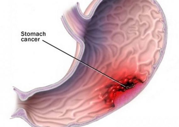 علایم سرطان معده