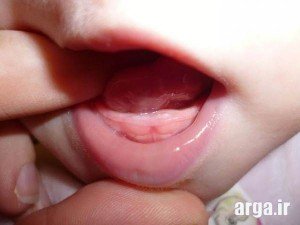دندان درآوردن کودک