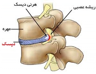 ورزش برای دیسک کمر