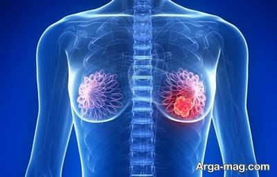 عواملی که خطر ابتلا به سرطان پستان را افزایش می دهد