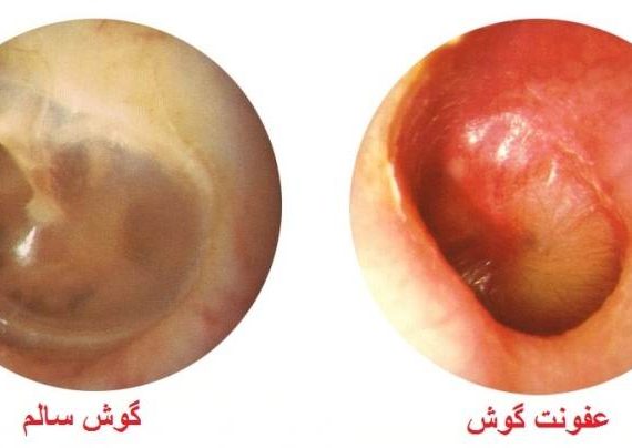 علل عفونت در گوش