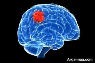 عواملی که خطر ابتلا به تومور مغزی را افزایش می دهد