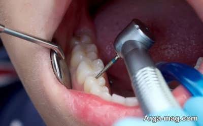 عصب کشی دندانها