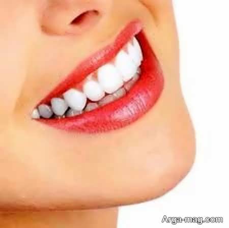 جرم گیری دندانها
