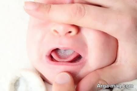 عواملی که خطر ابتلا به برفک دهان در نوزادان را افزایش می دهد.