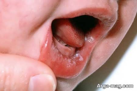 بررسی علل آفت دهان در کودکان