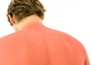 درمان خانگی و موثر آفتاب سوختگی