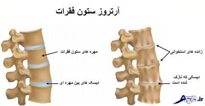 تاثیر گلوکزامین بر درمان درد مفاصل