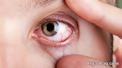 علل درد چشم