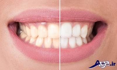 راه های سفید شدن دندان