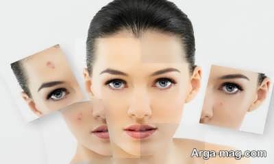 درمان جوش صورت با عسل با 4 روش مختلف 