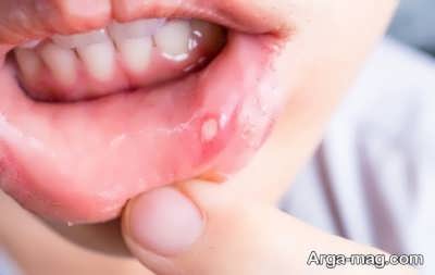 روش های درمان آفت دهان
