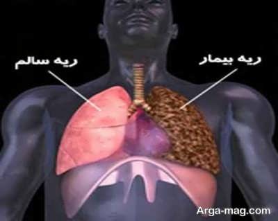 پیشگیری از سرطان ریه