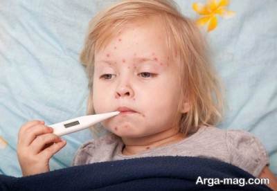 درمان سرخک در کودکان 