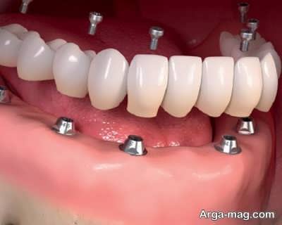 مزیت ایمپلنت دندان نسبت به بریج