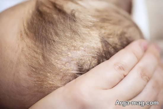 طریقه شست و شوی سر نوزاد در مواقع پوسته ریزی