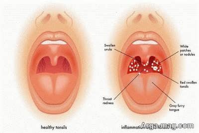 درمان زخم های دهانی با خرمالو