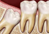 روش های خانگی و طبیعی برای تسکین درد دندان عقل