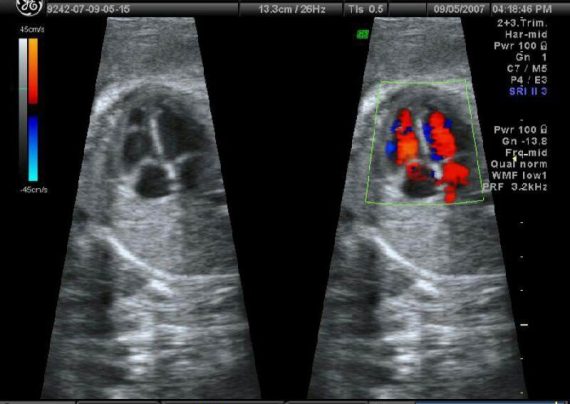 بهترین راه تشخیص مشکلات قلبی جنین با اکوی قلبی
