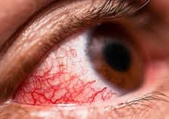 علائم عفونت چشم و درمان آن