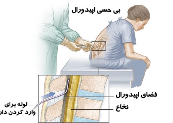 زایمان طبیعی اپیدورال