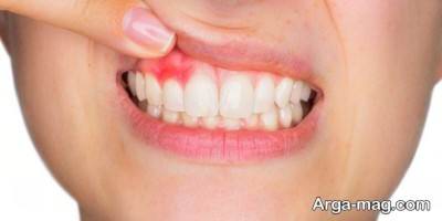 انواع قرص عفونت دندان