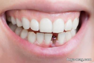 ایمپلت دندان چه عوارضی دارد