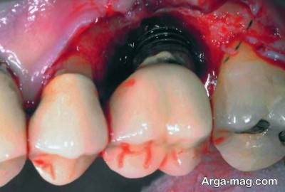 عوارض اسمپلنت دندان در کوتاه مدت