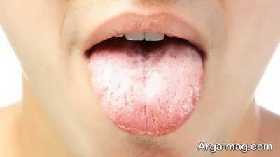 درمان خانگی برفک دهان