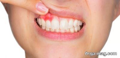 معجون های مفید برای رفع آبسه دندان