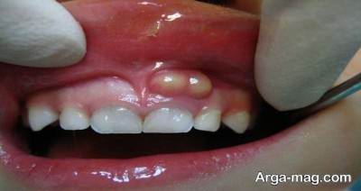 علت آبسه دندان