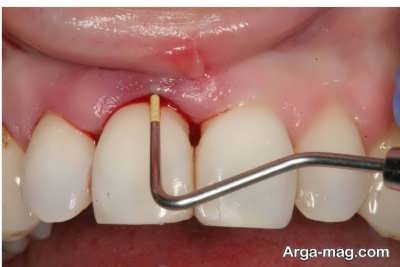  آشنایی با عوارض جرم گیری دندان