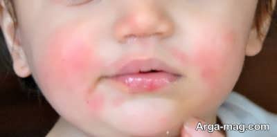بیماری پوستی در کودکان
