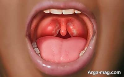 نشانه های گلودرد استرپتوکوکی