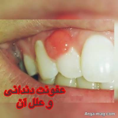 خونریزی لثه عفونی