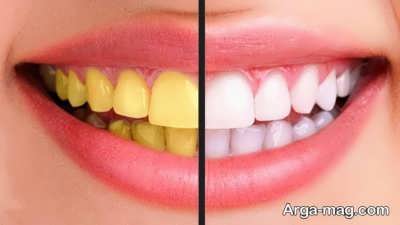 روشی برای از بین بردن زردی دندان