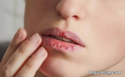 ترک ترک شدن لب